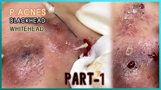 Big Cystic Acne Blackheads Extraction Blackheads amp Milia Whiteheads Removal Pimple Popping [upl. by Rammus418]