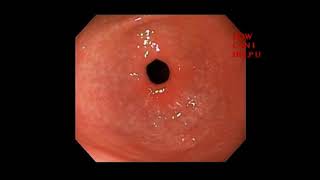 duodenitis [upl. by Cramer]