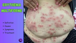 Erythema multiforme  Targetshaped lesions  All you need to know [upl. by Shae841]