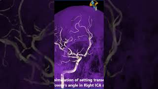 Setting Transorbital Projection for Right ICA Angiography shorts [upl. by Fanechka]