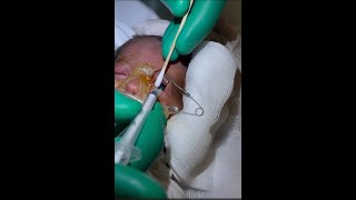 Retinopathy of Prematurity ROP Intravitreal Lucentis NICU [upl. by Auqinal]