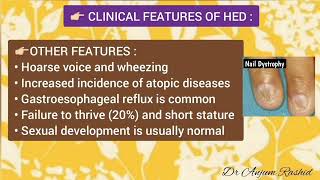 Ectodermal Dysplasia Symptoms Types Causes Diagnosis Treatment amp Life Expectancy [upl. by Elehcir]