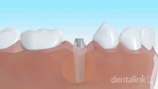 IMPLANTE DENTAL óseo integrado  Video 3D paso a paso [upl. by Lavotsirc]