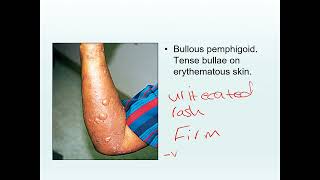 Bullous dermatosis [upl. by Tacye]