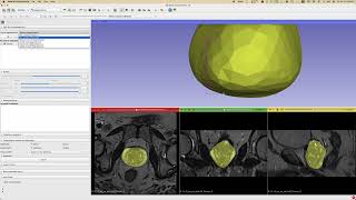 How to open DICOM Encapsulated STL files M3D in 3D Slicer [upl. by Hselin269]