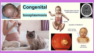 congenital toxoplasmosis [upl. by Aseela4]