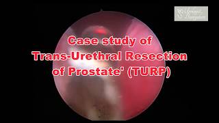 Transurethral Resection of Prostate In Bangalore  TURP Operation Karnataka  Prostate Surgery India [upl. by Fabrin]