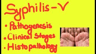 Syphillis Pathogenesis 2 Clinical Stages and Histopathology [upl. by Tayib]