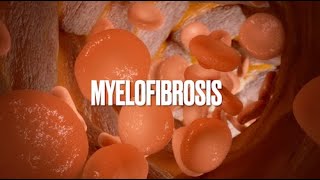 Understanding Agnogenic Myeloid MetaplasPrimary myelofibrosis PMFOsteomyelofibrosis bonemarrow [upl. by Redlac]