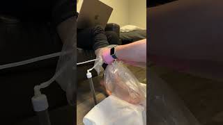 Limb Bagging Treatment [upl. by Dorahs]