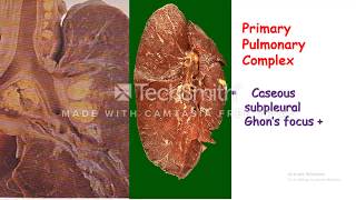 Primary Pulmonary Tuberculosis [upl. by Mcmullan]