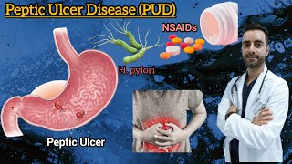 Peptic Ulcer Disease pathology  Peptic ulcer cause symptoms risk factors complication [upl. by Arnaud104]