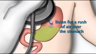 Nasogastric Tube Placement by S Hamilton  OPENPediatrics [upl. by Starkey]