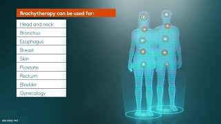 Brachytherapy an indispensable part of radiation therapy [upl. by Nuawtna]