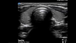 Ultrasound aided cricothyroid membrane identification [upl. by Willi903]