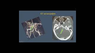 Retrosigmoid Craniotomy for Clipping of a Ruptured PICA Aneurysm [upl. by Renee]