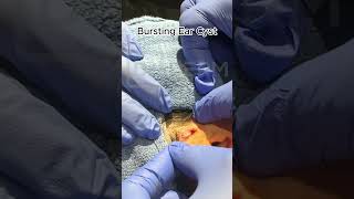 Bursting Ear Cyst  Dr Derm [upl. by Callahan410]