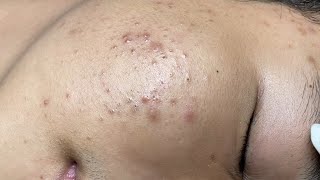 ACNE TREATMENT VU QUYNH MI  Blackheads Of Tweens 2024 EX [upl. by Jankell]