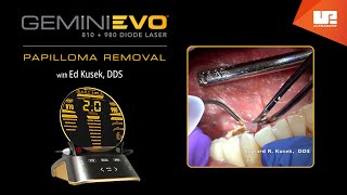 Papilloma Removal  Gemini™ EVO clinical cases [upl. by Inttirb690]