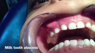 Milk Tooth Abscess [upl. by Elocn]