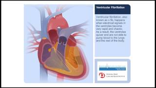 Ventricular Fibrillation Animation Video [upl. by Lednik]