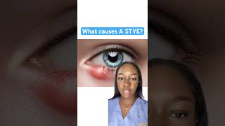 What causes styes on our eyes What causes boils [upl. by Ahsenar]