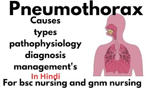 Pneumothorax [upl. by Nordna]