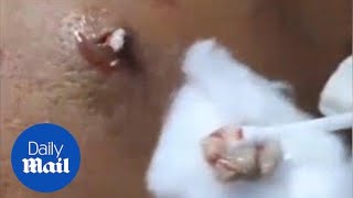 Dermatologist squeezes tenyearold spot on mans back in Hanoi [upl. by Ntsyrk600]