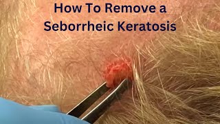 How To Remove a Seborrheic Keratosis [upl. by Ragan]