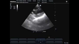 subcostal view of Kissing Heart in septic shock in patient with COPD [upl. by Arocat237]