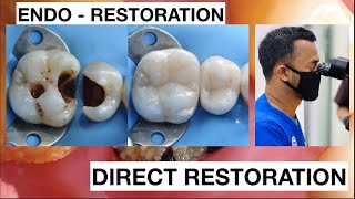 Dental Filling Procedure from Endodontic to Restoration Composite  General Dentist Griya RR [upl. by Nnaeitak68]