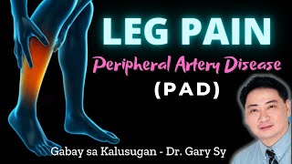 Leg Pain Peripheral Artery Disease PAD  Dr Gary Sy [upl. by Ellenehs879]