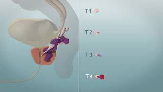 TNM classificatie stadium prostaatkanker [upl. by Mauro]