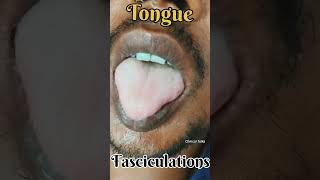 Tongue Fasciculations fasciculation snakebite neurotoxin clinicaltalks [upl. by Teressa642]