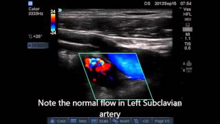 Emergency Ultrasound Case Acute Upper Limb Ischemia [upl. by Ystap]