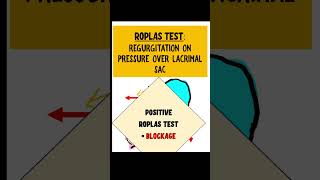 ROPLAS TEST dacryocystitis opthalmology [upl. by Sillaw]