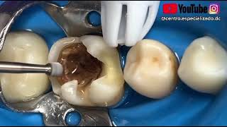 ¡Eliminando caries profunda de una muela [upl. by Deborah]