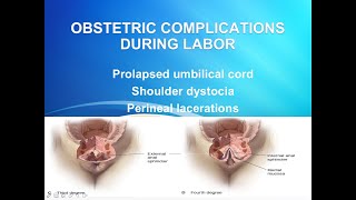 Obstetric complications during labor [upl. by Dajma]