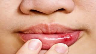 Difference Between Cold Sore and Herpes [upl. by Ruthie359]