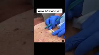 Blackheads Popping amp Blackhead Removal Videos 2022 [upl. by Neit]