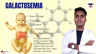 WHAT IS GALACTOSEMIA   CLINICAL ASPECTS  DIAGNOSIS  ENZYME DEFICIENT  TREATMENT [upl. by Beauvais64]