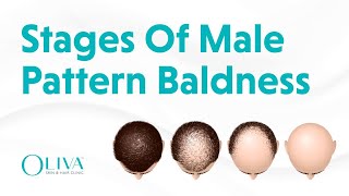 7 Stages of Male Pattern Baldness Explained by The Best Dermatologist  Oliva skin amp Hair Clinic [upl. by Aronoel]