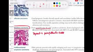 Thyroid cancer papillary follicular Medullary anaplastic endocrinology 54  usmle Step 1 [upl. by Auot]