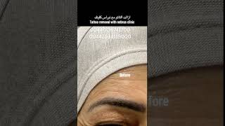 ازالة التاتو اكسبلور 00447736741700 كيفيه skintagremoval المستوي skincare التركيز تجميل [upl. by Garry583]