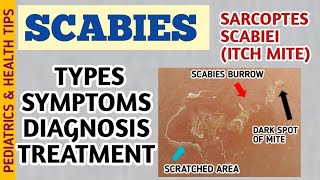 Scabies Classic Crusted Nodular Scabies Symptoms Diagnosis and Treatment  Itch Mite [upl. by Powell440]