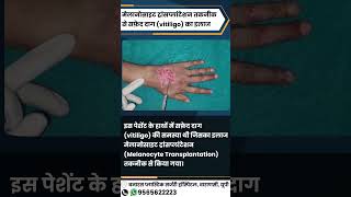 मेलानोसाइट ट्रांसप्लांटेशन तकनीक से सफ़ेद दाग Vitiligo का इलाज MelanocyteTransplantation [upl. by Demahom255]