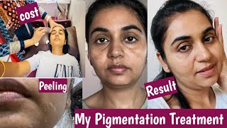 My Pigmentation Treatment  Yellow Peeling for dark spots pigmentation darkspots treatment [upl. by Ennis953]