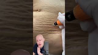 Plasma Pen As A Cure For Stretchmarks  Doctor Reacts [upl. by Ping]