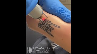 Tattoo removal at Advanced Dermatology and Cosmetic Surgery [upl. by Ailicec]