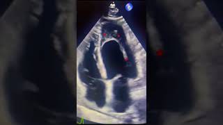 Eosinophilic myocarditis echocardiography cardiology heart clinical [upl. by Ignatzia]